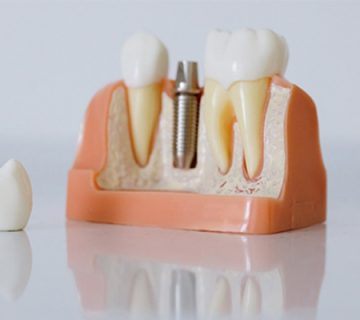 tooth pin