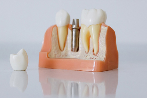 tooth pin