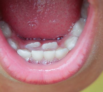 Extra teeth in children's gums