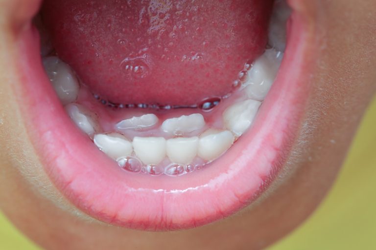 Extra teeth in children's gums