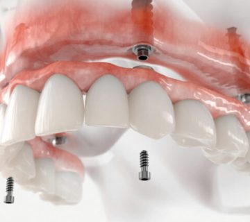 Movable prostheses
