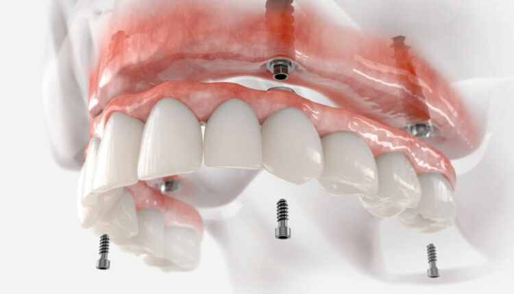 Movable prostheses