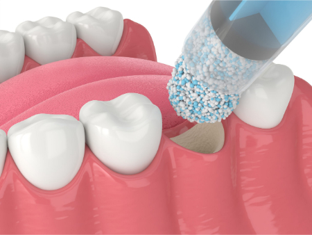 The use of hydrogels in bone tissue engineering