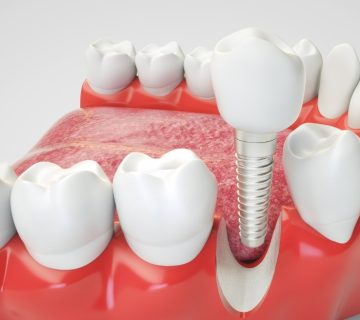 Infectious risks for oral implants