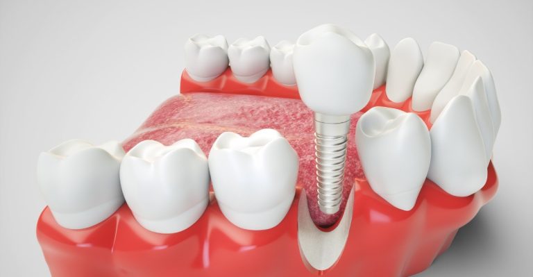 Infectious risks for oral implants