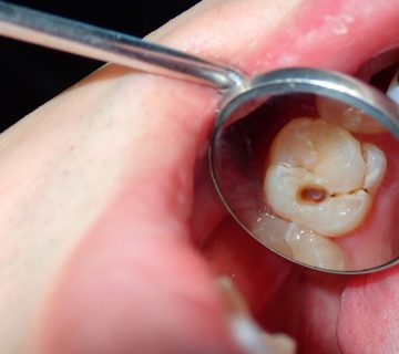 tooth necrosis