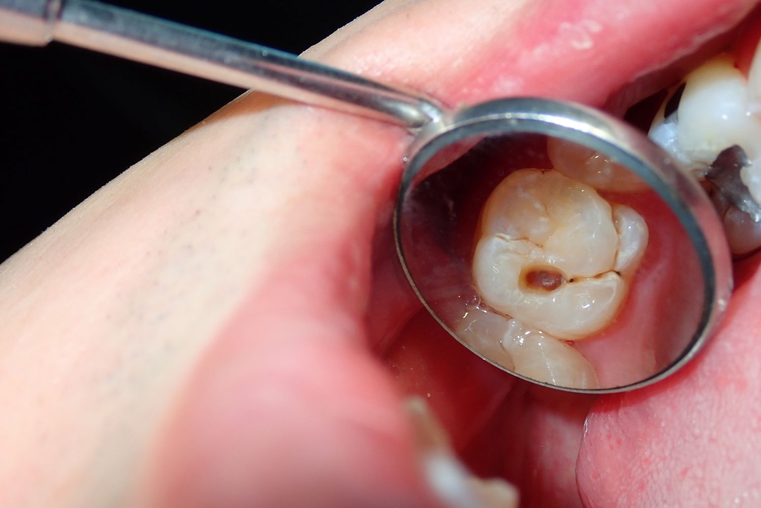tooth necrosis