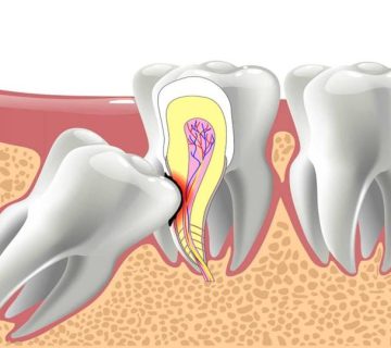 Complications of not pulling wisdom teeth