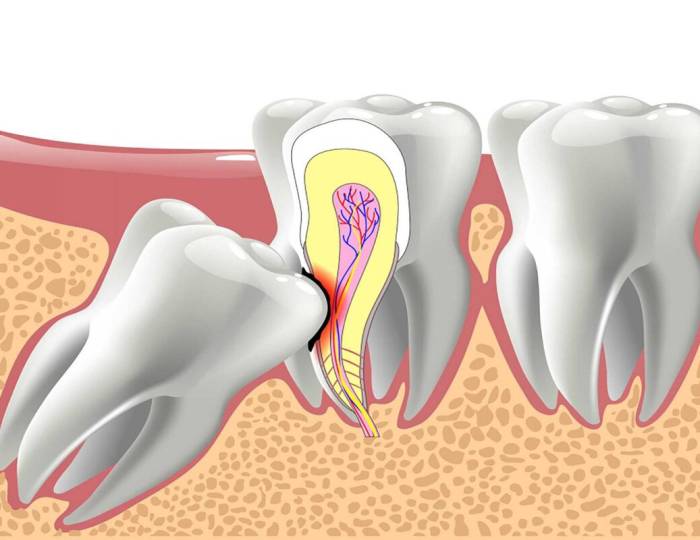 Complications of not pulling wisdom teeth