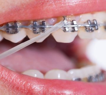Benefits of orthodontics for adults