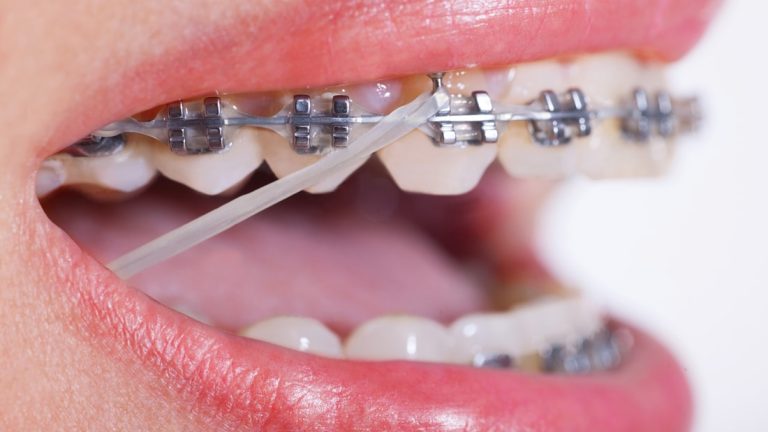 Benefits of orthodontics for adults