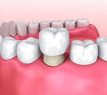 Post-root canal care and crowns