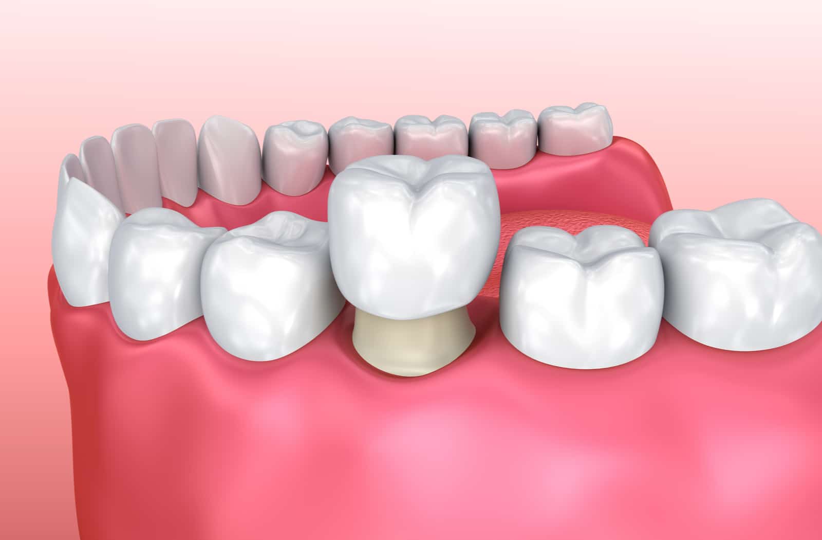 Post-root canal care and crowns
