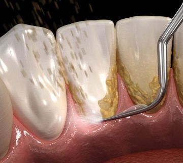 Duration of dental scaling