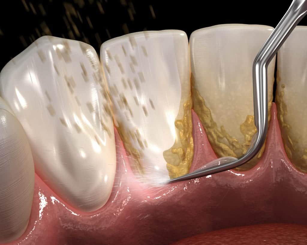 Duration of dental scaling