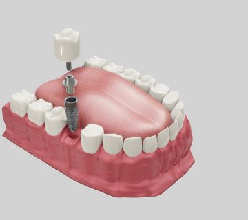 Dental implants in Karaj