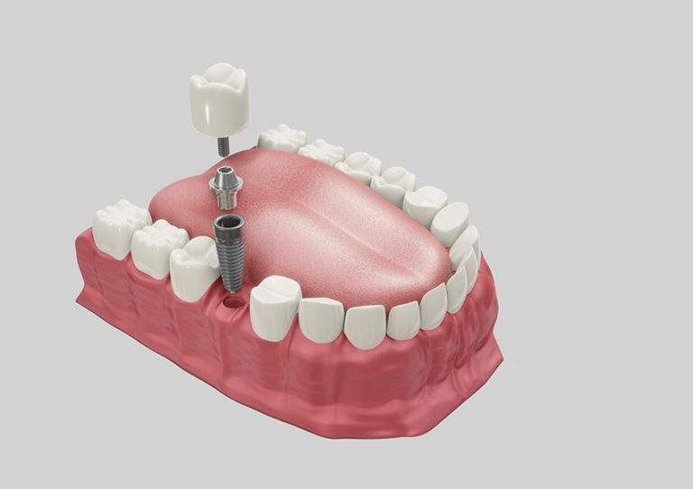 Dental implants in Karaj