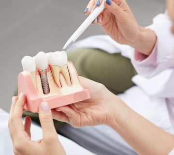 Benefits of having implants at Arghavan Dental Clinic, Karaj