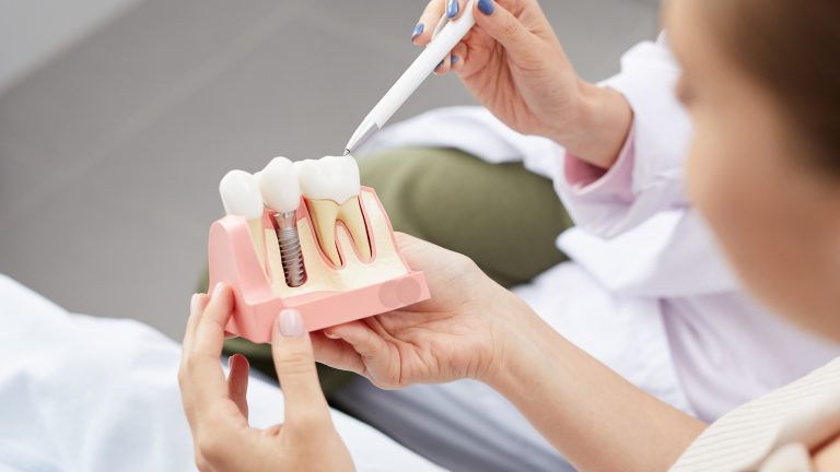 Benefits of having implants at Arghavan Dental Clinic, Karaj