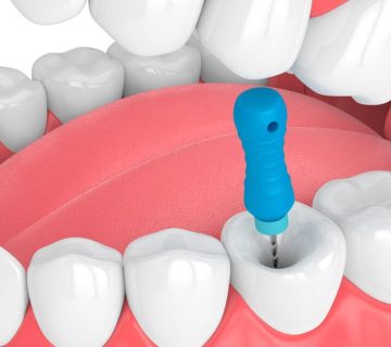 The process of root canal treatment or endo