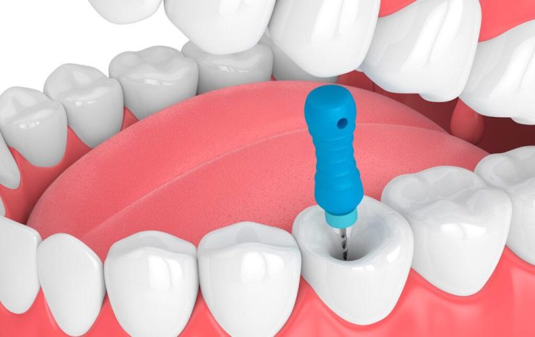 The process of root canal treatment or endo