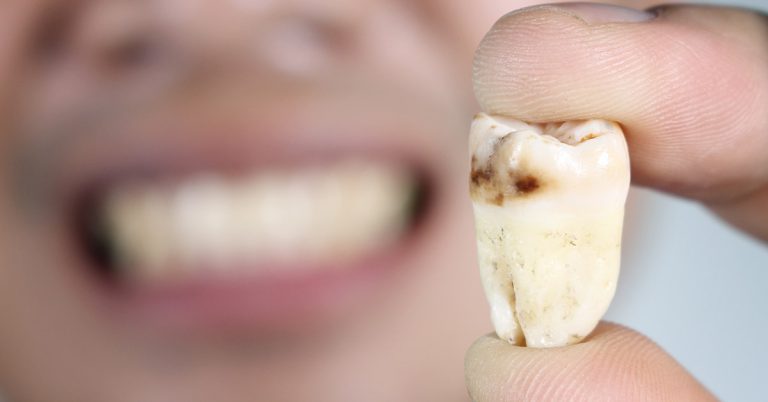 Tooth decay