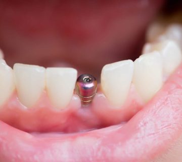 Dental implants in Karaj with Arghavan Clinic