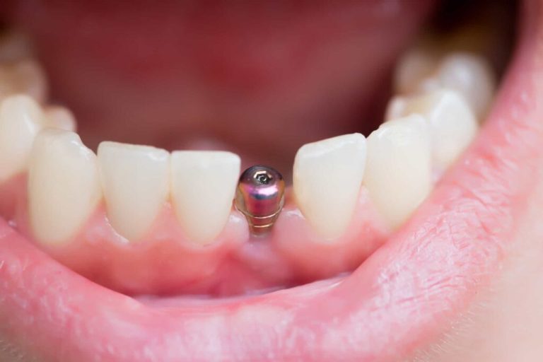 Dental implants in Karaj with Arghavan Clinic