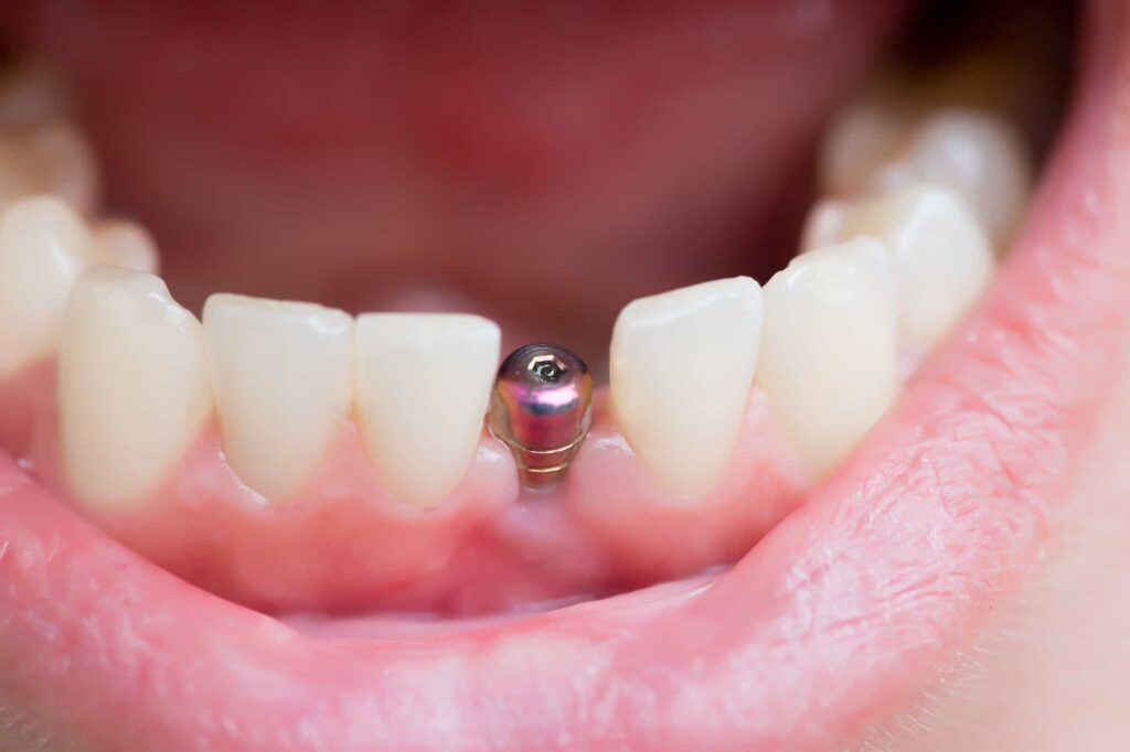 Dental implants in Karaj with Arghavan Clinic