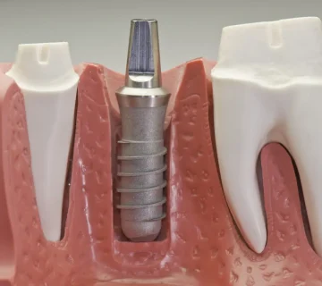 Implant pain