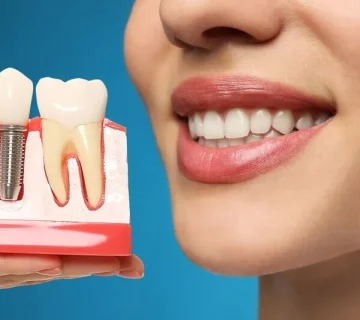 The best choice for dental implants in Karaj