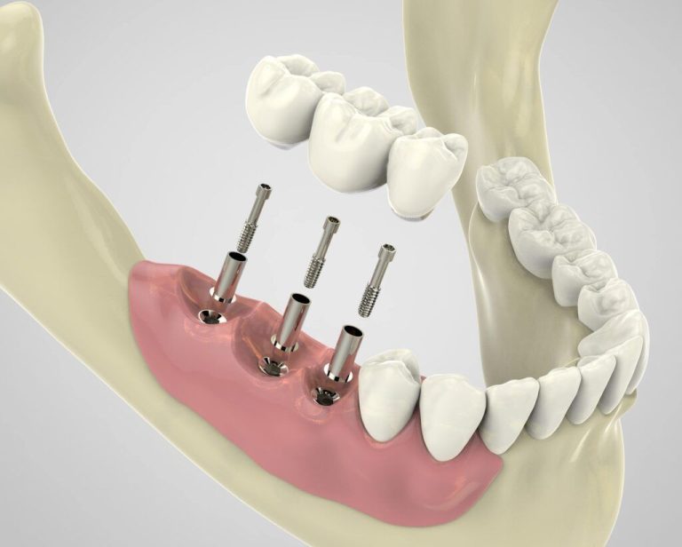 Steps for performing dental implants in Karaj