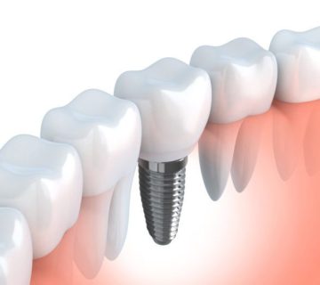 Implant surgery at Arghavan Dental Clinic