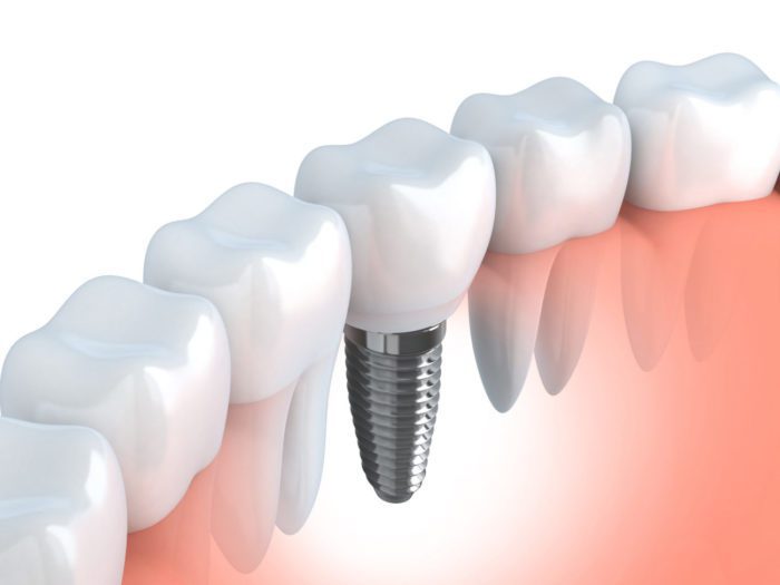 Implant surgery at Arghavan Dental Clinic
