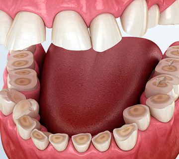 Oral and dental diseases
