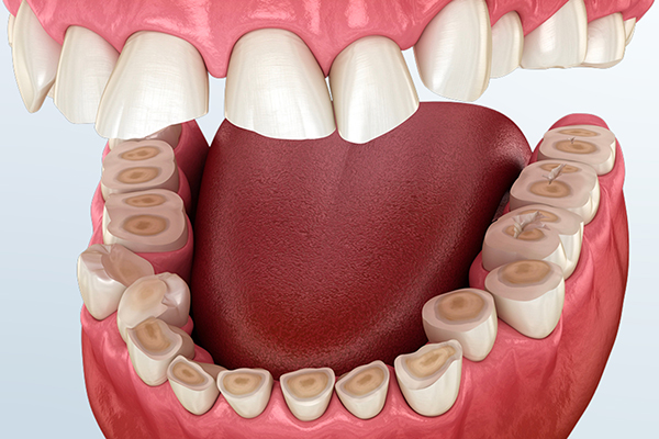 Oral and dental diseases