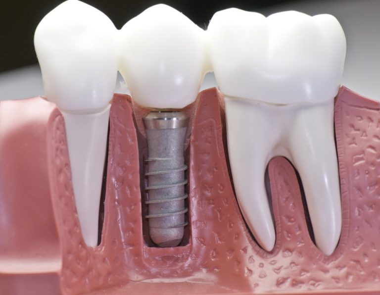 Complete steps for dental implant surgery