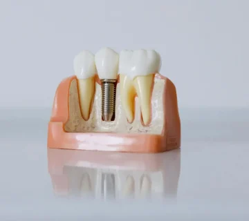 Dental implant