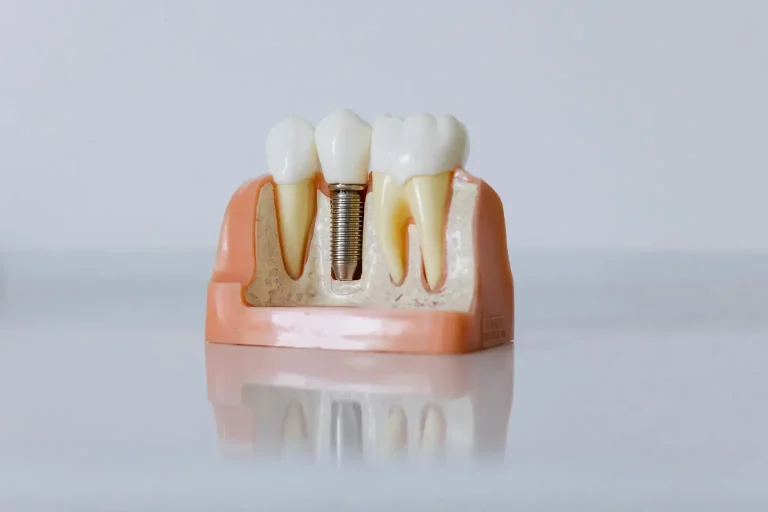 Dental implant