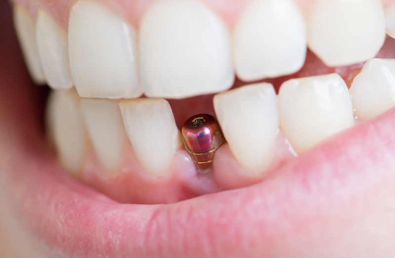 Dental implants for front teeth