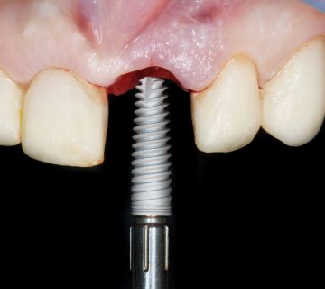 Possible complications of dental implants