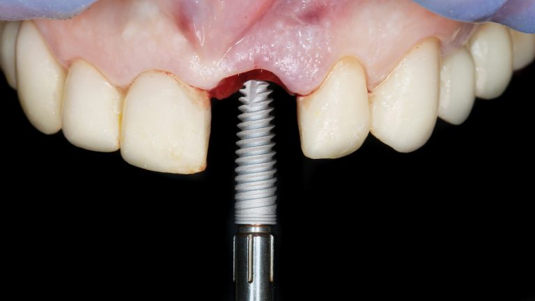 Possible complications of dental implants
