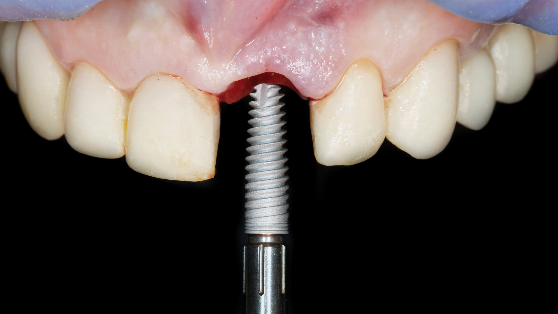 Possible complications of dental implants