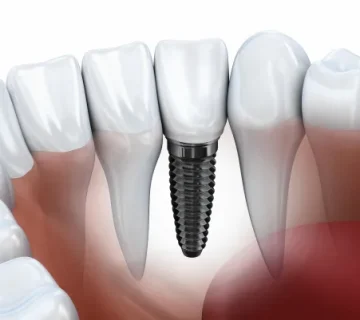 Implant surgery