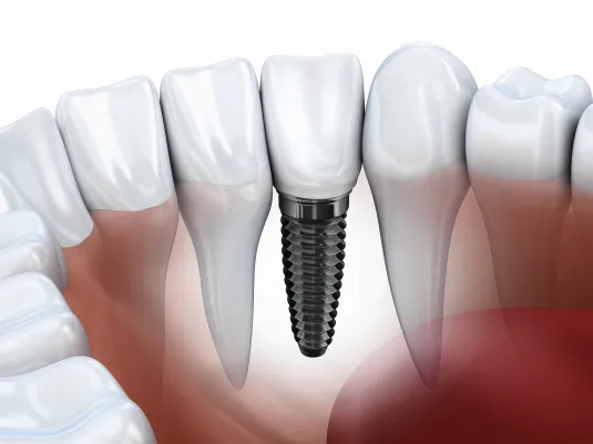 Implant surgery