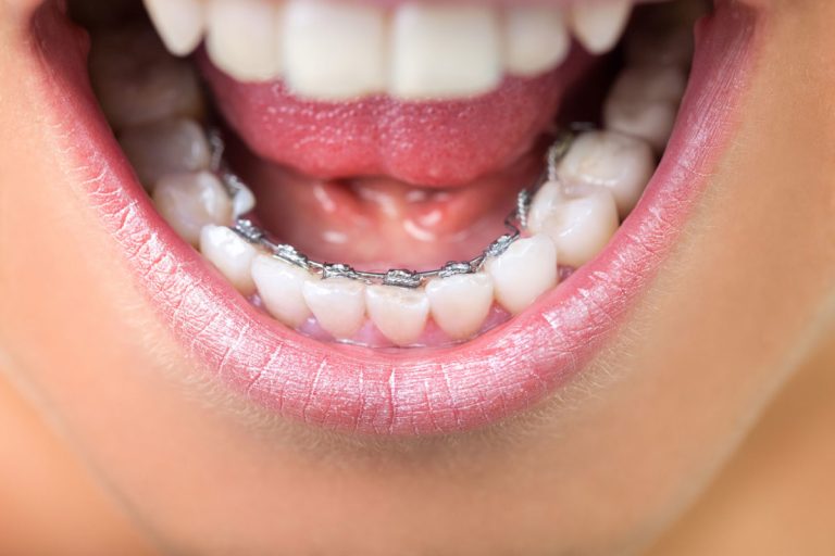 Upper and lower teeth