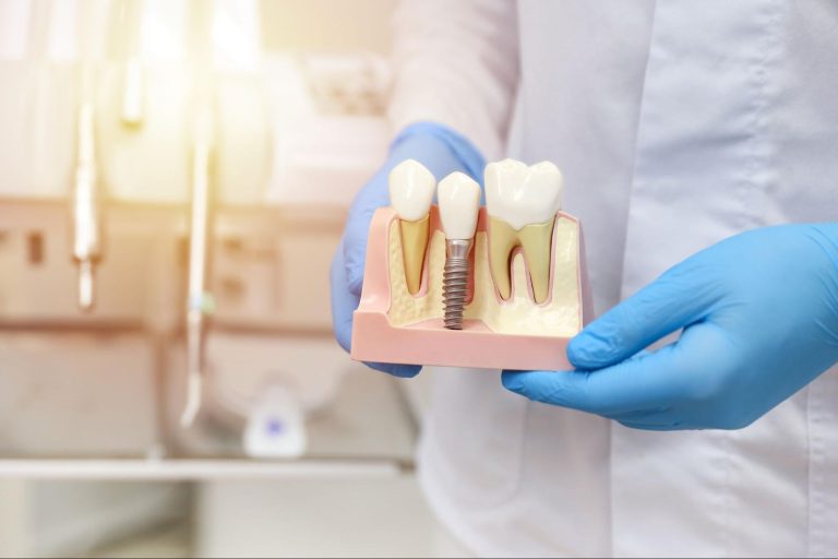 Implant lifespan
