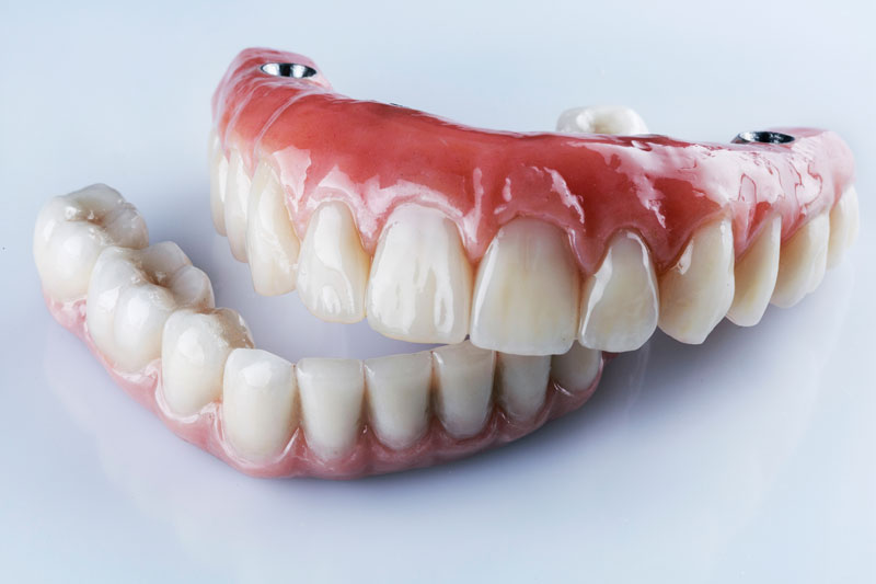 Dental implant