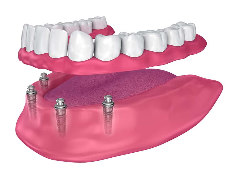 Movable prosthesis