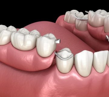 پروتز دندان